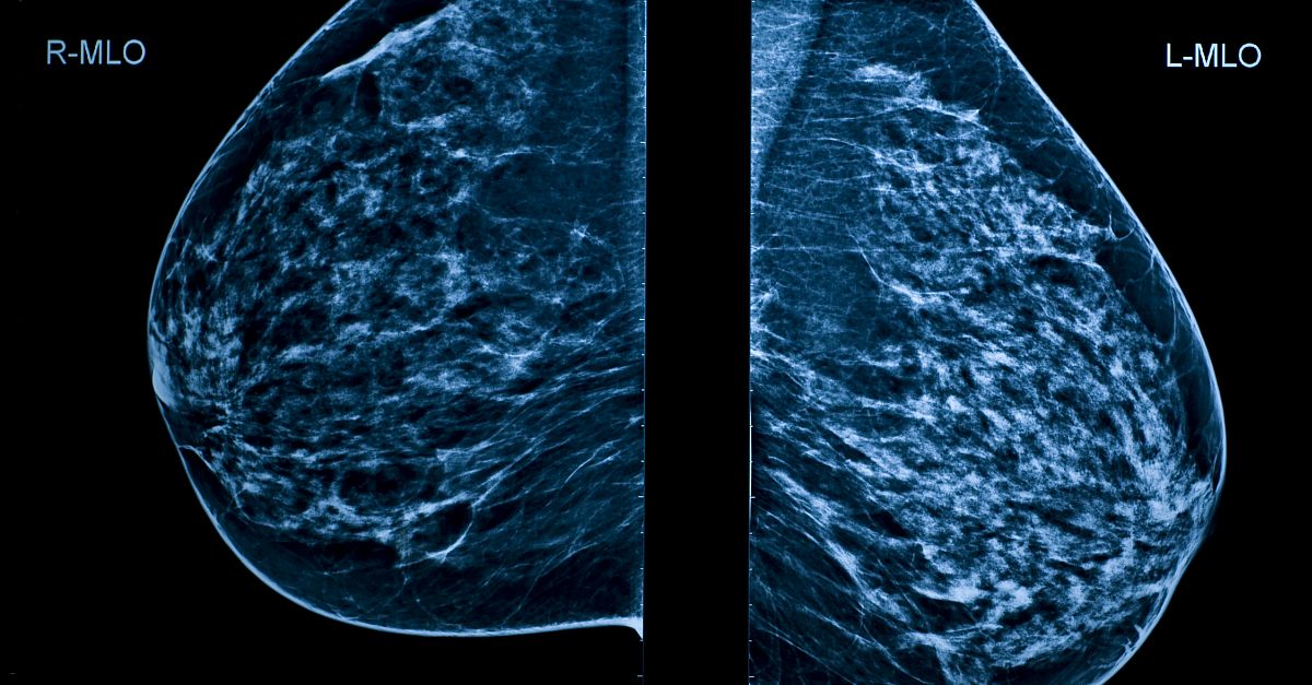 Artificial Intelligence (AI) Computer-aided Detection (CAD) Shows Promise for Breast Cancer Screening