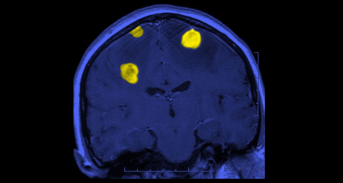 recent advances treatment increased complexity management brain metastases Aptitude Health